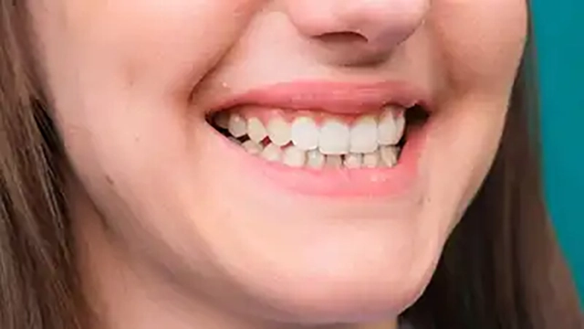 teeth whitening